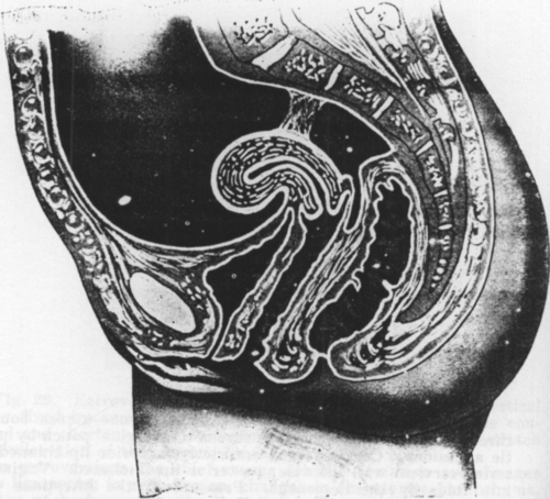 Fig. 31. Retroposition of the Uterus. The uterus is drawn backward into retroposition by peritoneal bands of adhesions, extending from the supravaginal portion of the cervix to the sacrum (Findley, Diseases of Women.)