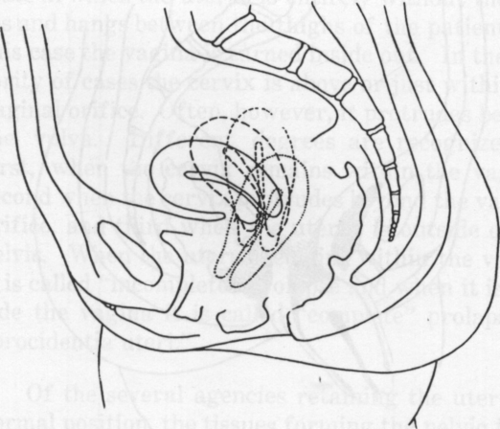 Fig. 37. Degrees of Incomplete Prolapse.