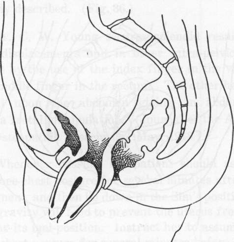 Fig. 38. Complete Prolapse.