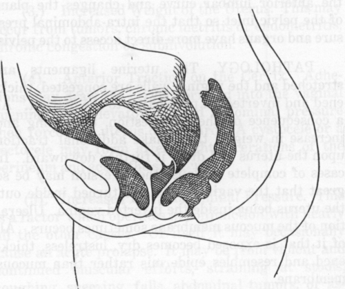 Fig. 39. Cystocele and Rectocele. Sectional View 