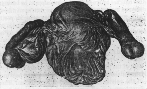 Fig. 46. Double pyohydrosalpinx, Chronic Adhesive Perimetritis and Oophoritis. Both tubes are almost filled with pus, the fimbriated ends, walled off both from the isthmus and from the peritoneal cavity, are transformed into cysts. (Schaeffer, Atlas and Epitome of Gynecology.)