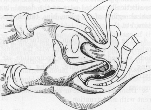 Fig. 7. Showing the use of the unflexed third and fourth fingers in examination and treatment, also the approximation of the fingers with only the vaginal and abdominal walls intervening in bi manual examination before attempting to palpate the separate organs.