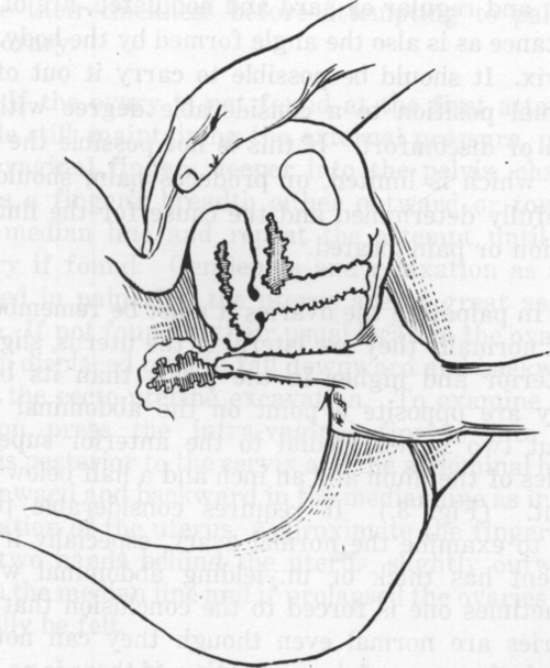 Fig. 8. Recto abdominal Palpation.