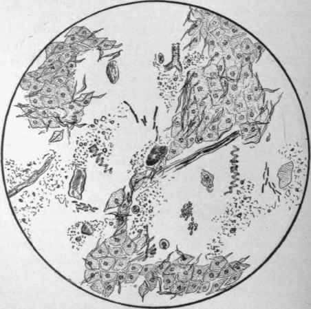 Fro. 21.   Specimen of Stool of Mrs. V.. with Chronic Intestinal Catarrh. Groups of epithelial cells; detritus; a few muscle cells, partly digested; plant cells; bacteria; yeast cells.