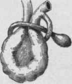 Knotting of a Meckel's Diverticulum
