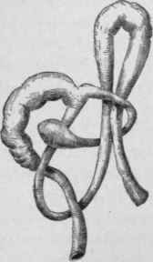 Knotting of a Meckel's Diverticulum