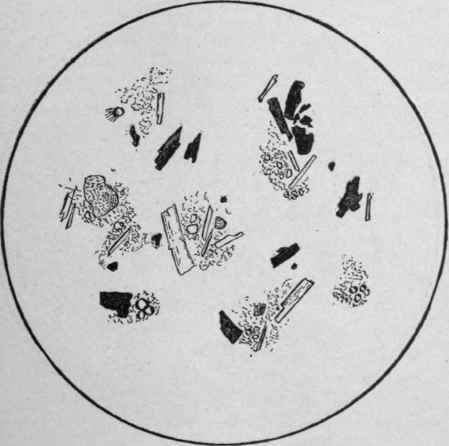 Specimen of Stool of Mrs