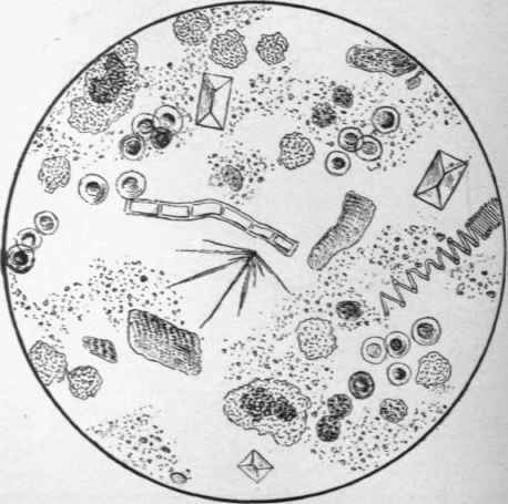Stool of Patient H