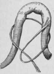 Types of Constricting Peritonitic Bands