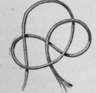 Types of Constricting Peritonitic Bands