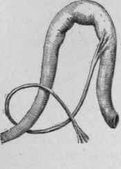 Types of Constricting Peritonitic Bands