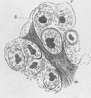 a transverse section of a colloid cancer