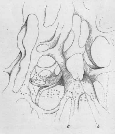 multilocular, fibro membranous stroma of colloid cancer