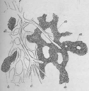 stages of the development of medullary carcinoma