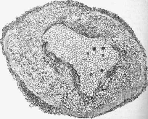 A blood vessel from the medulla oblongata in a case of hydrophobia.