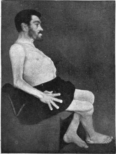 Acromegaly in a man aged forty nine.