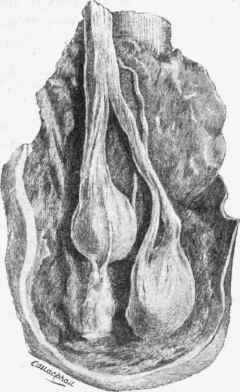 Amputation neuromata in a stump.