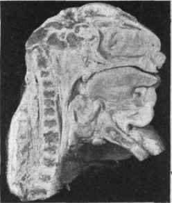 Anencephalus in median section.