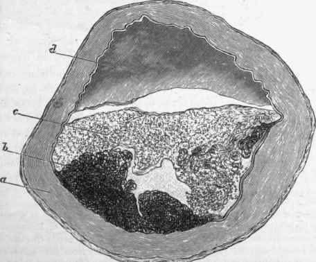 Atheroma of cerebral artery.
