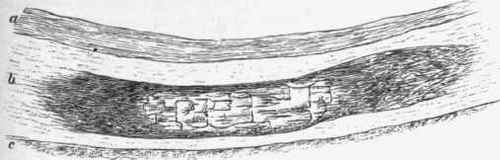 Calcareous infiltration of the middle coat of an artery.