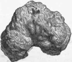 Calcified myoma of uterua found lying in the cavity.