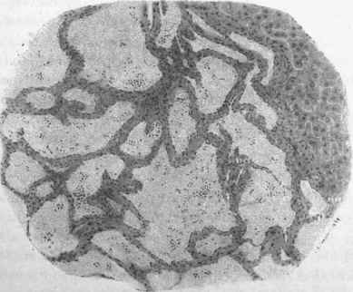 Cavernous angioma of liver.