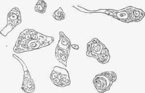 Cells in the juice scraped from a scirrhus of mamma.