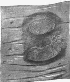 Cicatrices on a Peyer's patch from typhoid fever.