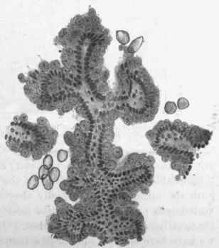 Coccidiosis. Liver of rabbit. From same case as Fig. 162.