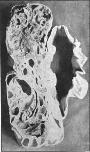 Colloid ovariuu cystoma in section after hardening.