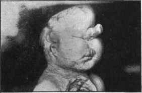 Cyclopia.