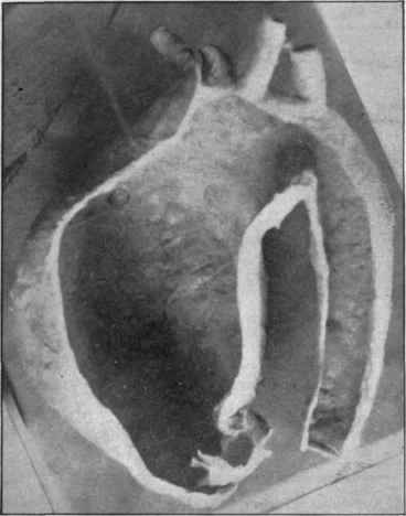 Dilatation of aortic arch. The vessel is shown laid open from the valve onwards.