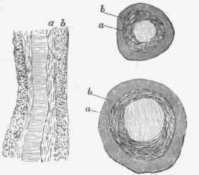 Endarteritis obliterans in arteries of kidney: a, thickened and fibrous internal coat; b, middle coat.