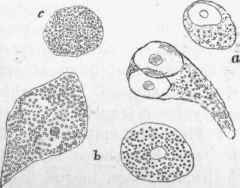 Fatty degeneration of cells in a cancer of the mamma: a, slightly affected; b, more so; c, completely fatty   the compound granular corpuscle, x 350.