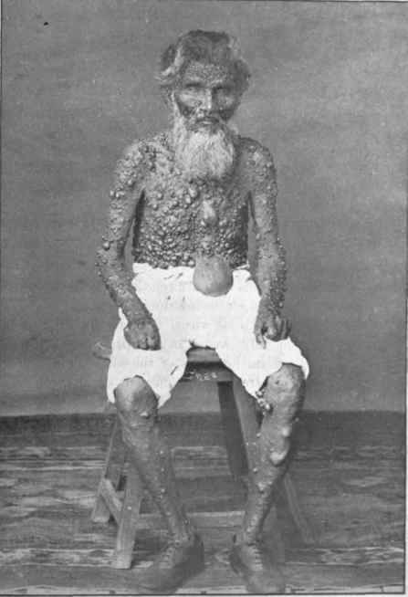 Fiberoma moluscum in a man aged eighty five years, who bad been affected for forty four years.