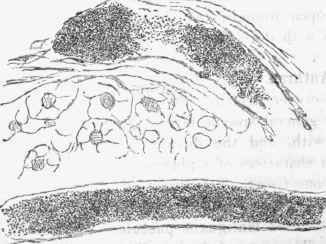 From the skin in a case of erysipelas.