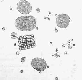 From vomited matter, showing (a) sarcinae ventriculi, (b) starch granules, and (c) fungus spores, x 350.