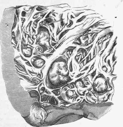 Globular thrombi near the apex of the left ventricle.