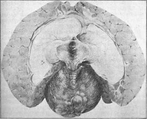Great dilatation of the lateral ventricles (which have been laid open) from tumour of the cerebellum.