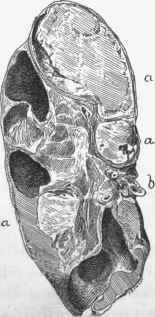 Healed pyonephrosis. 6, obliterated pelvis; a, a, a, cavities filled with pultaceous matter.