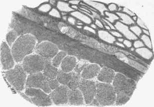 Hepatization of lung.