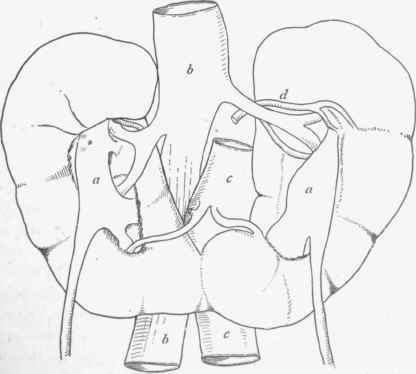 Horse shoo kidney, a, a, pelves with ureters, the latter coming off from the external instead of the internal borders.