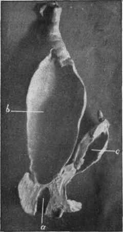 Imperforate anus, a, Anus and anal part of rectum, b, Dilated rectum separated from anal part by a complete septum, c, Urinary bladder.