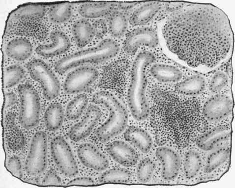 Kidney in leukaemia.