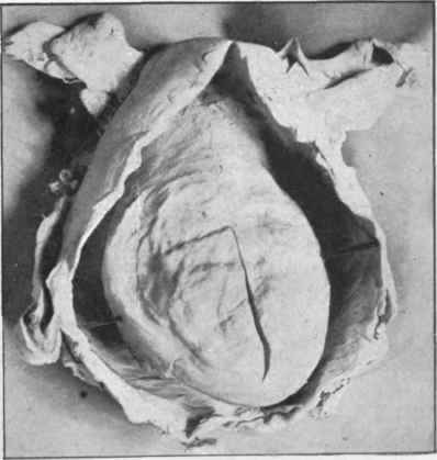 Largo submucous myoma attached near the fundus and distending uterus and vagina.