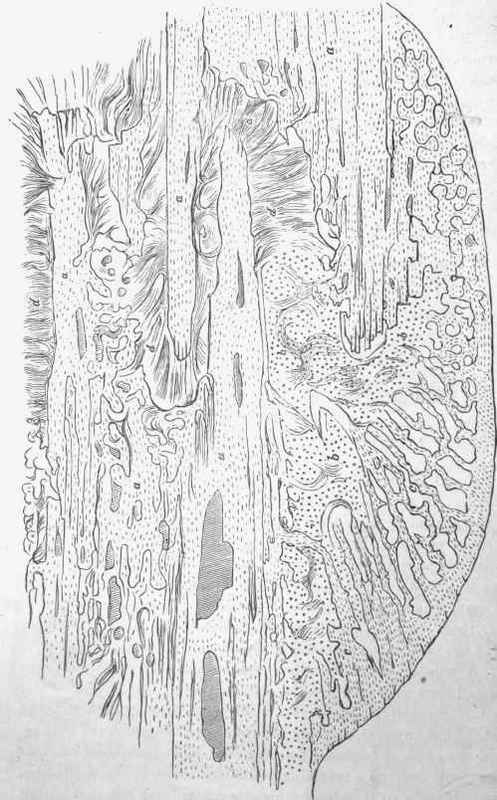Longitudinal section of a fractured rib, showing callus, etc.