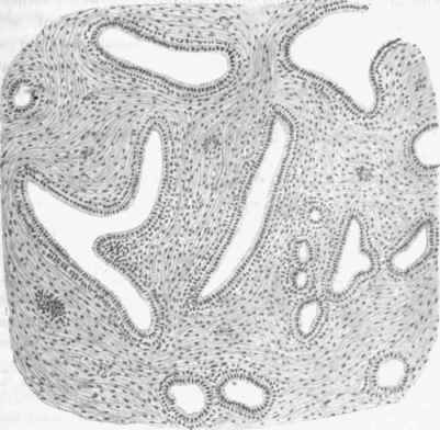 Mammary adenoma. Gland tissue with partial dilatation of duct.