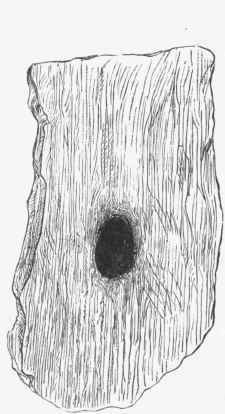 Perforating ulcer in lower part of aesophagus.