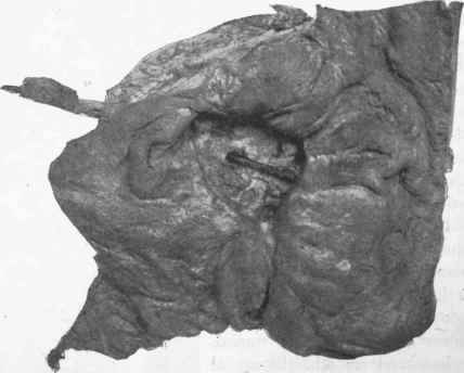 Perforating ulcer of duodenum opening into gastro epiploic artery and resulting in fatal haemorrhage.