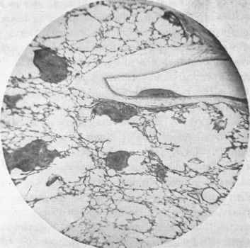 Photograph of a section of lung in a case of acute general tuberculosis.
